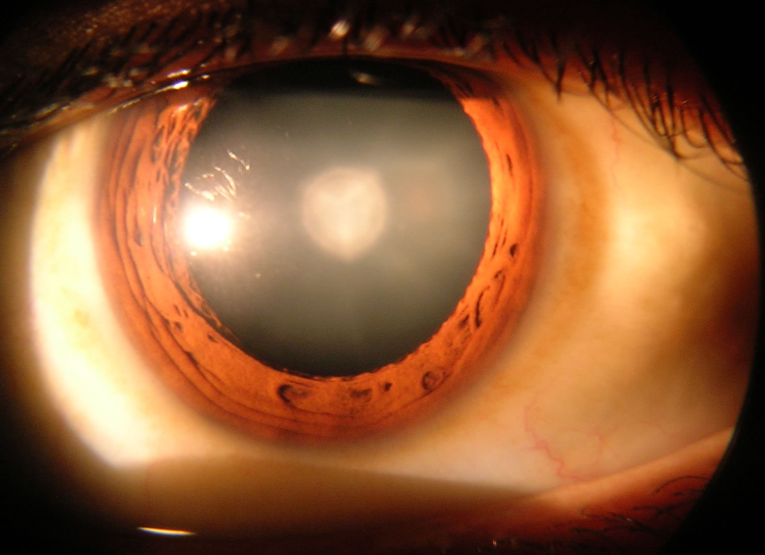 A cataract in a human eye